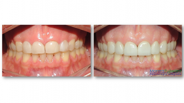 porcelain veneers for crowded teeth