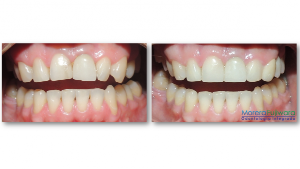 veneers2