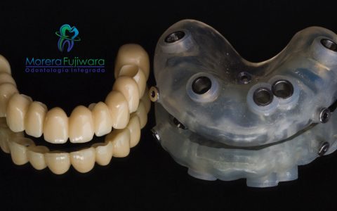 Computer Guided Dental Implants Costa Rica