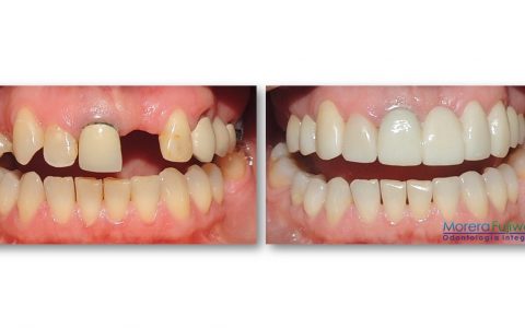 Before and After Dental Implants Costa Rica